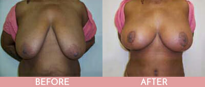 Breast Reduction Before and After, Montclair, NJ and New York (NY)