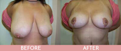 Breast Reduction Before and After, Montclair, NJ and New York (NY)
