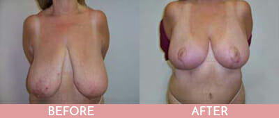 Breast Reduction Before and After, Montclair, NJ and New York (NY)