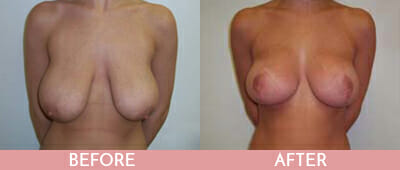 Breast Reduction Before and After, Montclair, NJ and New York (NY)
