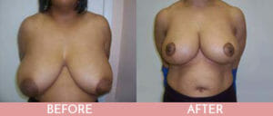 Breast Reduction Gallery