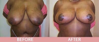 Breast Reduction Before and After, Montclair, NJ and New York (NY)