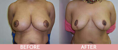 Breast Reduction Before and After, Montclair, NJ and New York (NY)