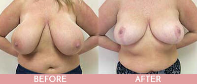 Breast Reduction Before and After, Montclair, NJ and New York (NY)
