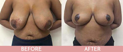 Breast Reduction Before and After, Montclair, NJ and New York (NY)