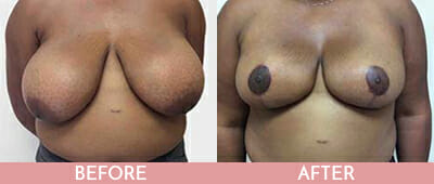 Breast Reduction Before and After, Montclair, NJ and New York (NY)