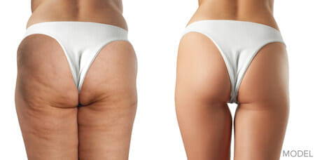 Cellulaze™ Surgery Montclair New Jersey