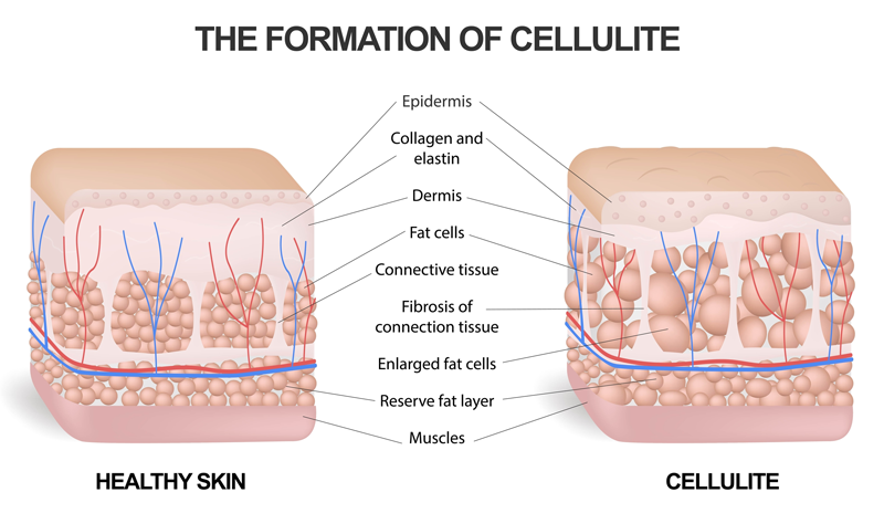 Cellulaze Surgery Services Montclair New Jersey