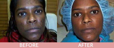 Chemical Peels Before and After, Montclair, NJ and New York (NY)