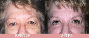 Eyelid Lift Gallery