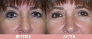 Eyelid Lift Gallery