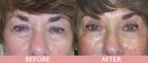 Eyelid Lift Gallery