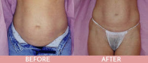 Liposuction Gallery