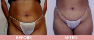 Liposuction Gallery