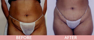 Liposuction Before and After, Montclair, NJ and New York (NY)