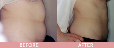 Liposuction Before and After, Montclair, NJ and New York (NY)