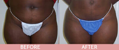 Liposuction Before and After, Montclair, NJ and New York (NY)