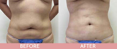 Liposuction Before and After, Montclair, NJ and New York (NY)