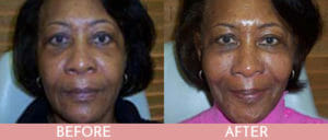 Liquid Facelift Gallery