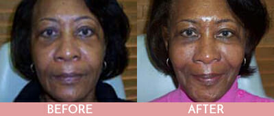 Liquid Facelift Before and After, Montclair, NJ and New York (NY)