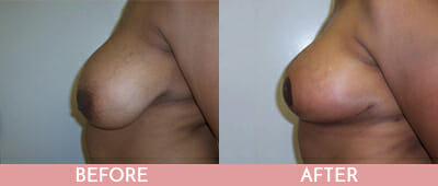 Mommy Makeover Before and After, Montclair, NJ and New York (NY)