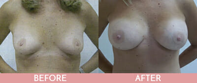 Mommy Makeover Before and After, Montclair, NJ and New York (NY)