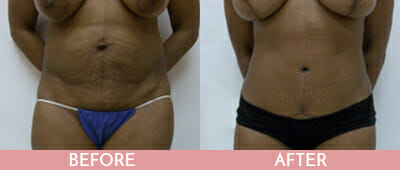 Mommy Makeover Before and After, Montclair, NJ and New York (NY)