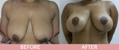 Mommy Makeover Before and After, Montclair, NJ and New York (NY)