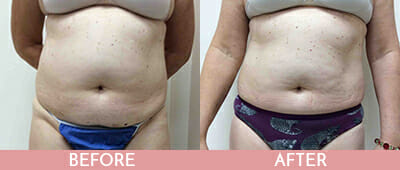 SculpSure® WarmSculpting™ Before and After, Montclair, NJ and New York (NY)