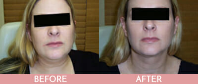 SmartLipo™ Before and After, Montclair, NJ and New York (NY)