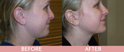 SmartLipo™ Before and After, Montclair, NJ and New York (NY)