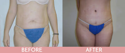 SmartLipo™ Before and After, Montclair, NJ and New York (NY)