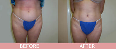 SmartLipo™ Before and After, Montclair, NJ and New York (NY)
