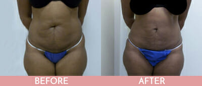 SmartLipo™ Before and After, Montclair, NJ and New York (NY)