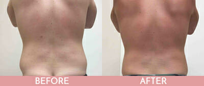 SmartLipo™ Before and After, Montclair, NJ and New York (NY)