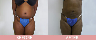 SmartLipo™ Before and After, Montclair, NJ and New York (NY)