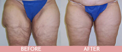 Thigh Lift Before and After, Montclair, NJ and New York (NY)