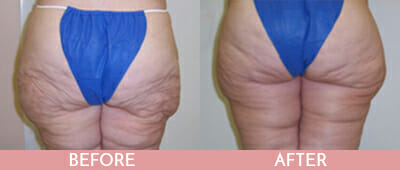 Thigh Lift Before and After, Montclair, NJ and New York (NY)