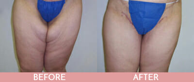 Thigh Lift Before and After, Montclair, NJ and New York (NY)