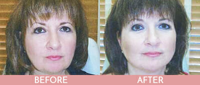 Thread Lift Before and After, Montclair, NJ and New York (NY)