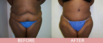 Tummy Tuck Before and After, Montclair, NJ and New York (NY)