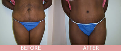 Tummy Tuck Before and After, Montclair, NJ and New York (NY)