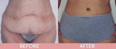 Tummy Tuck Before and After, Montclair, NJ and New York (NY)