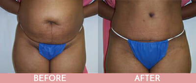 Tummy Tuck Before and After, Montclair, NJ and New York (NY)