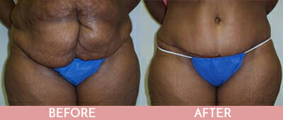 Tummy Tuck Before and After, Montclair, NJ and New York (NY)