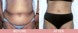 Tummy Tuck Gallery