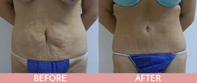 Tummy Tuck Before and After, Montclair, NJ and New York (NY)