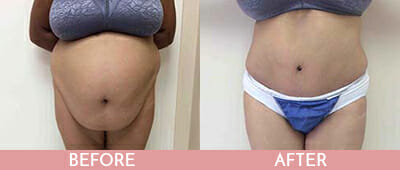 Tummy Tuck Before and After, Montclair, NJ and New York (NY)