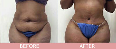Tummy Tuck Before and After, Montclair, NJ and New York (NY)