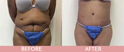 Tummy Tuck Before and After, Montclair, NJ and New York (NY)